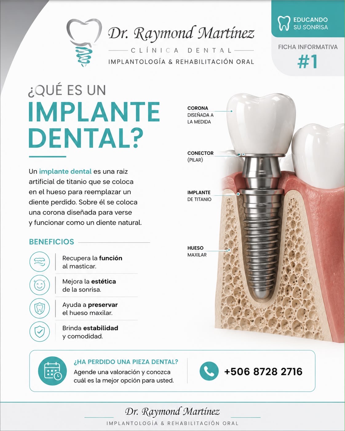 ¿Qué es un implante dental?